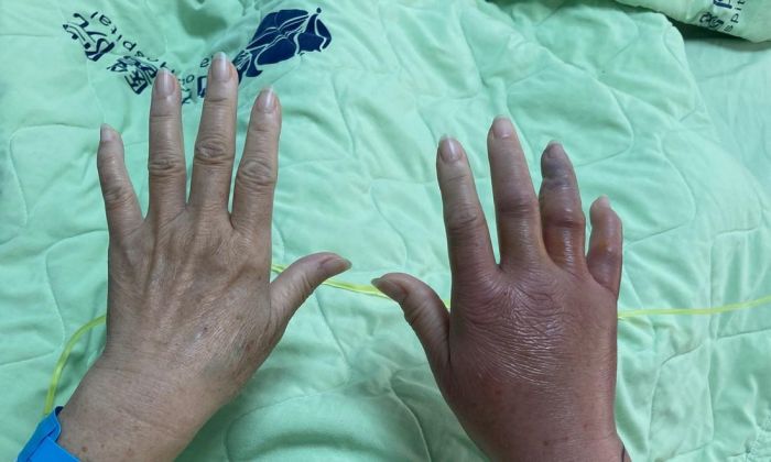 被刺小傷口感染海洋弧菌 整手發黑蔓延腫脹險喪命