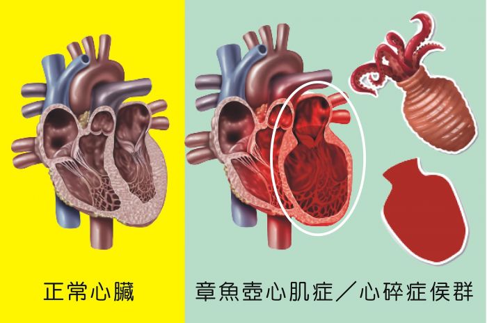 不可不知的「心碎症候群」 難過到心碎恐致命