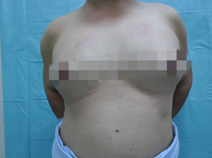 男高中生男性女乳症被譏可當女優 整形平胸撫創傷