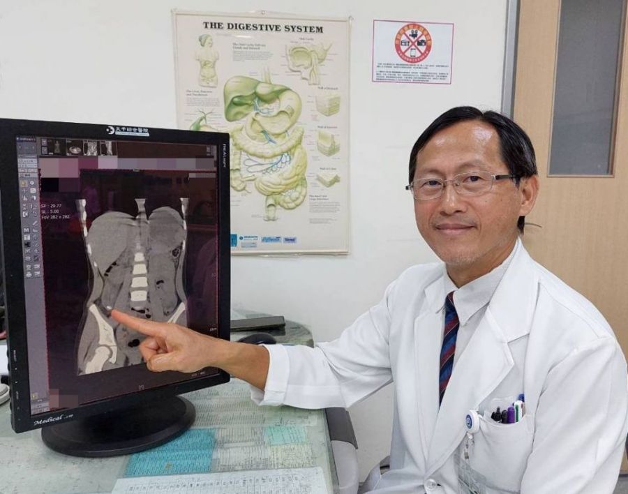 4歲幼童嘔吐腹痛誤為腸胃炎  檢查竟是急性闌尾炎破裂引發腹膜炎