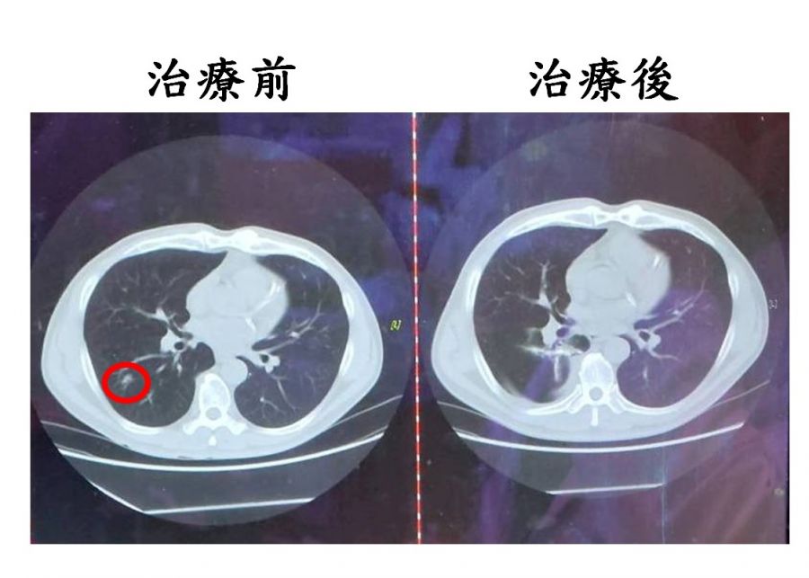 LDCT揪早期肺癌  搭配微創胸腔鏡手術  助扭轉病情