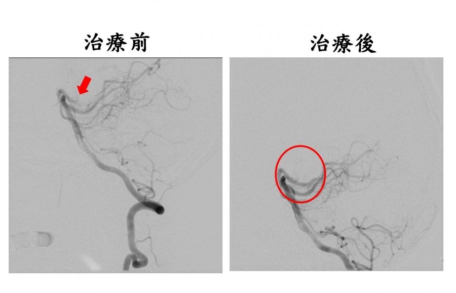 血栓溶解搭配動脈取栓術  黃金時間救治缺血型腦中風