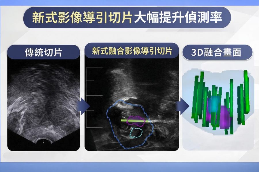 攝護腺特異抗原指數異常！ 彰基以「攝護腺切片影像導引融合系統」揪出癌病灶
