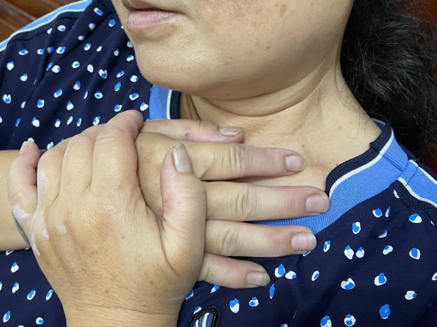 婦人不喝酒卻得食道癌　秀傳醫院揪出胃食道逆流惹的禍